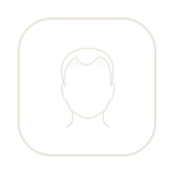 Alopecia Androgenética